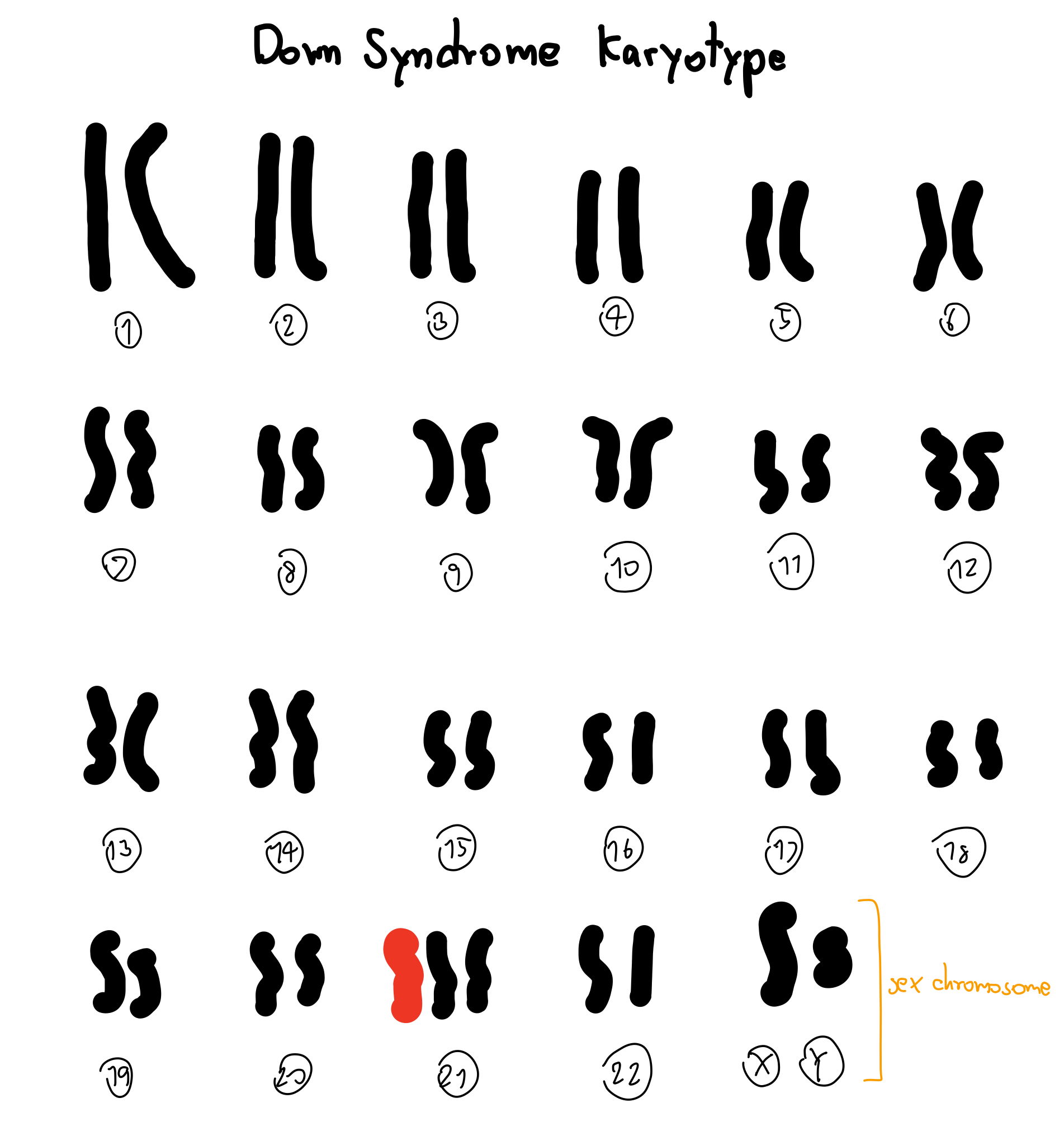 Down syndrome Karyotype
